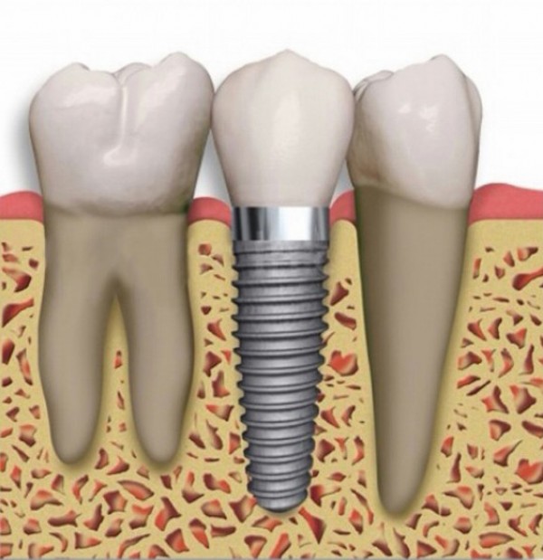 Implants