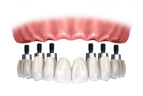 Pròtesi dentals