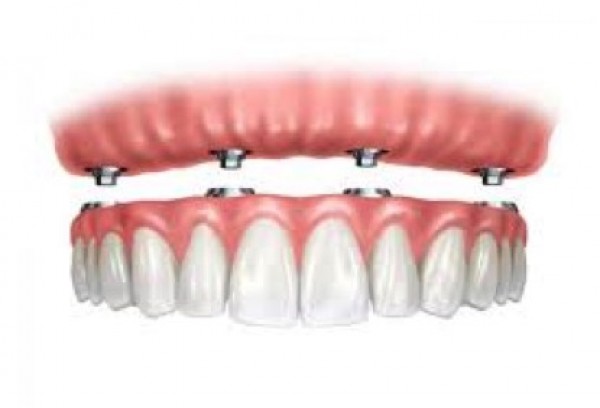 Pròtesi dentals