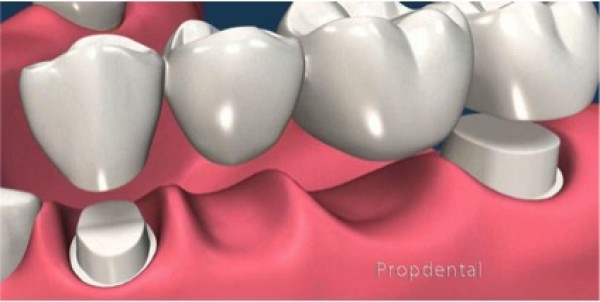Pròtesi dentals