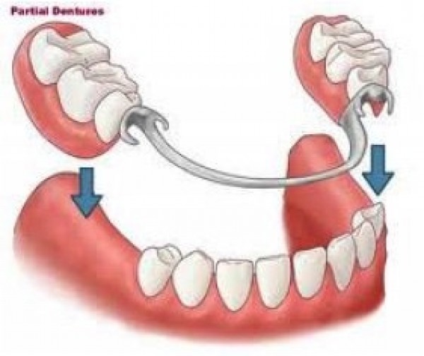 Pròtesi dentals