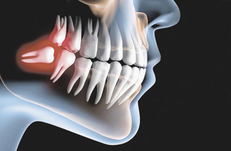 Cirurgia oral