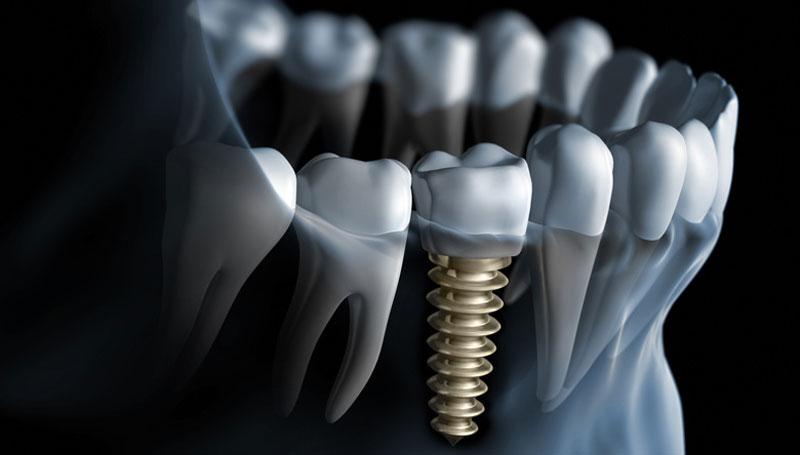 Implants